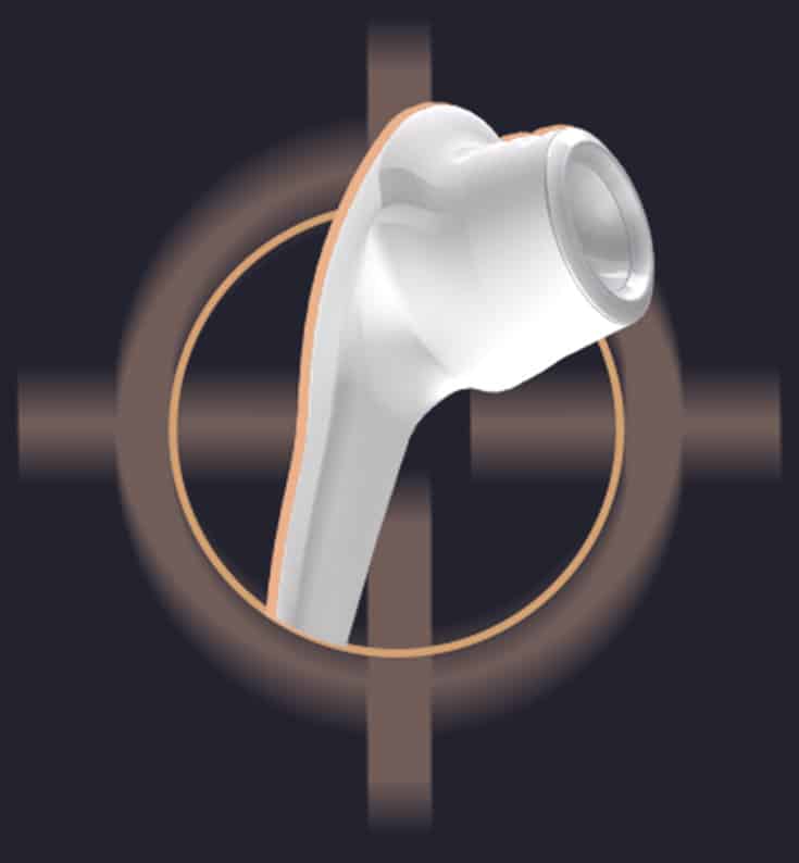 Aplicador HIFU Ultrassom Microfocado, Macrofocado, Sonofocus