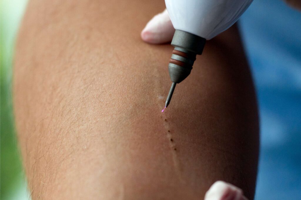 Jato de Plasma da IBRAMED, Plasmed, realizando protocolo de melhora da aparência da cicatriz