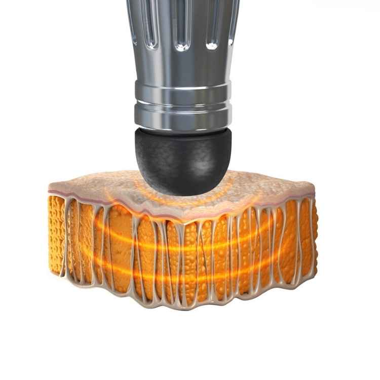 Ondas de Choque na gordura - Thork da IBRAMED