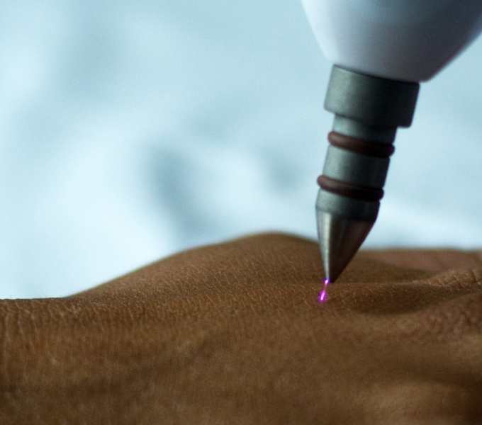 Jato de Plasma no modo fulguração