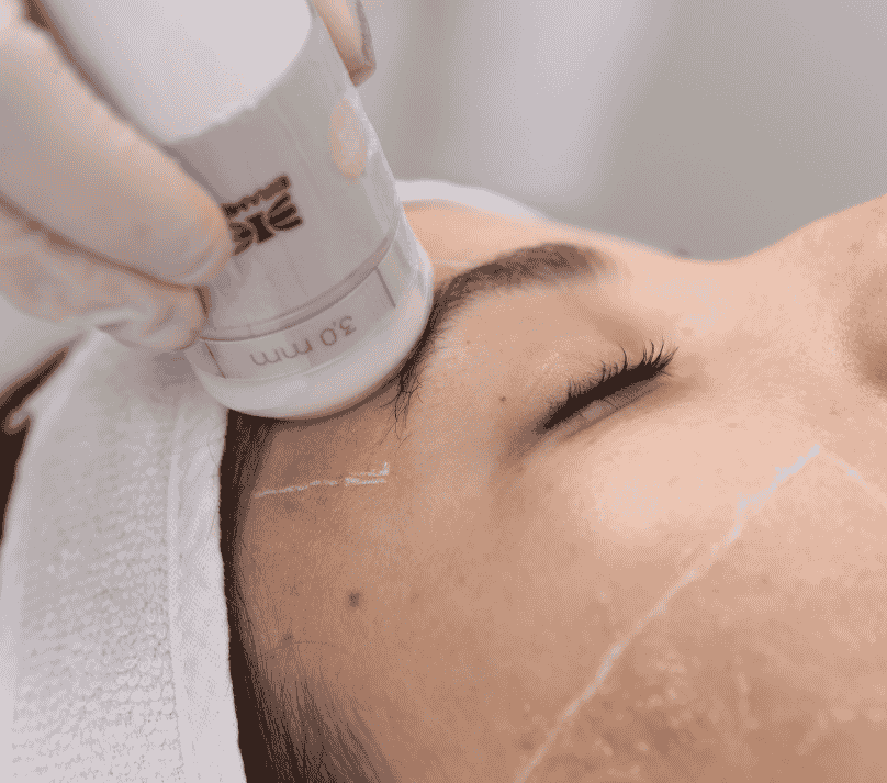 Harmonização Orofacial com Ultrassom Microfocado - Tendências para 2025