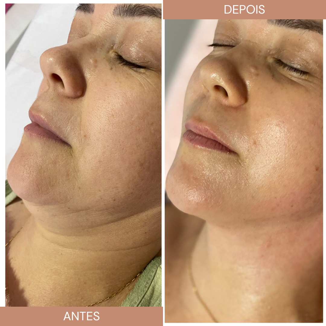 ultrassom_microfocado_tratamentos_facial_sonofocus_ibramed_ultrassom_sem_cartuchos.jpg