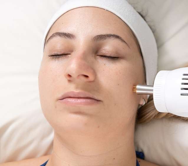 Radiofrequência Fracionada com Cryotecar - equipamentos de estética