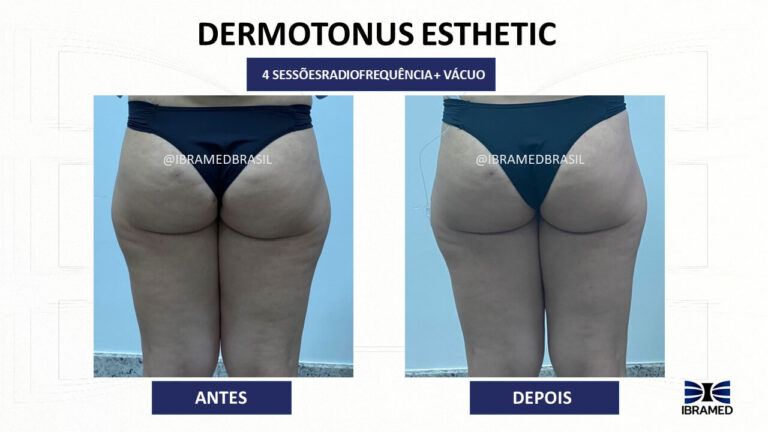 Radiofrequência + Vácuoterapia para celulite. Resultado de Antes e depois com o Dermotonus Esthetic da IBRAMED