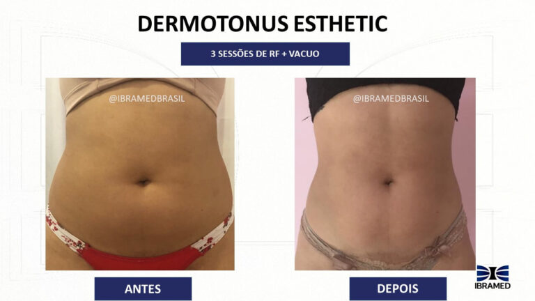 Radiofrequência + Vácuoterapia para gordura localizada. Resultado de Antes e depois com o Dermotonus Esthetic da IBRAMED