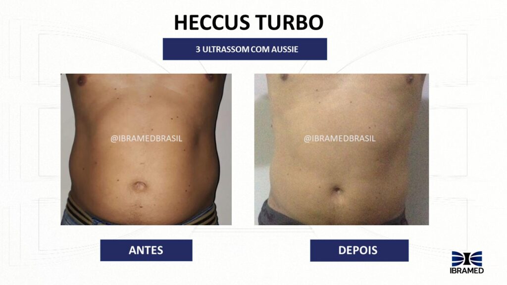 Ultrassom Terapêutico associado a eletroestimulação